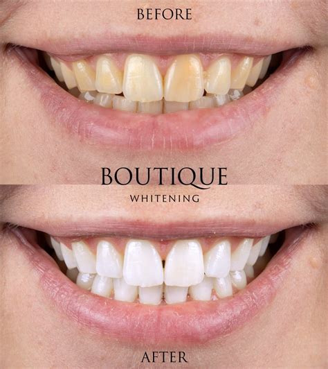 teeth whitening leatherhead|Tooth whitening in Leatherhead, Surrey, Ashtead, Tyrells Wood, .